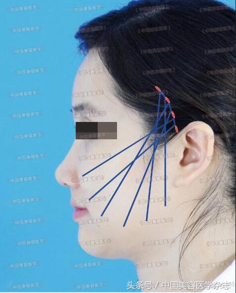 小切口线雕面部提升术视频,线雕面部提升术危害