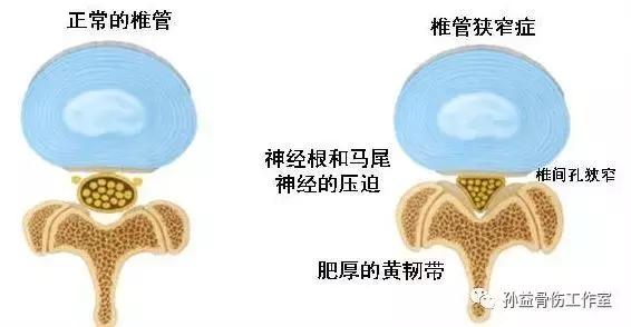 腰痛治疗的求本之法——恢复腰部结构及气场的稳态