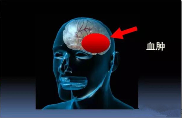 创伤性脑积水与创伤后脑积水,脑外伤后脑积水怎么消除