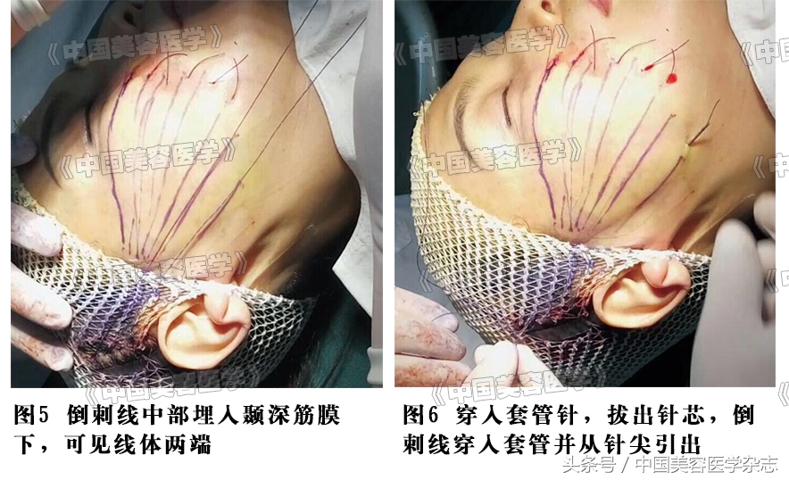 小切口线雕面部提升术视频,线雕面部提升术危害