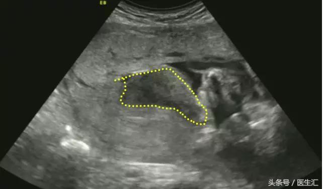 胎盘早剥是什么导致的,胎盘早剥是什么原因造成的胎儿肺炎