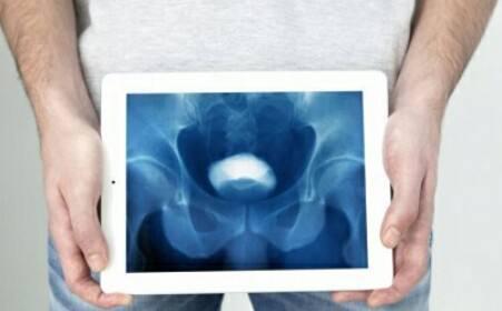 年龄比较大膀胱癌患者怎么治疗,膀胱癌怎么预防应该吃什么补品