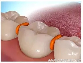 牙齿矫正的过程能参加篮球比赛吗,牙齿矫正过程中掉了可以找医院吗