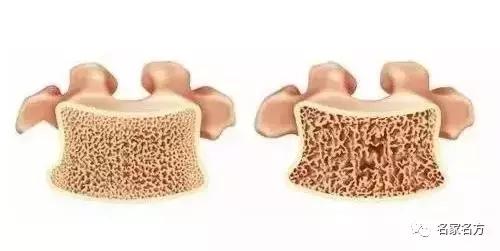 你的骨头正在泡沫化!知名康复专家:一颗洋葱就能帮你找回骨本