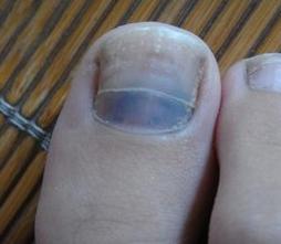 有灰指甲的人的鞋子怎么处理,灰指甲治好了鞋子还能穿吗