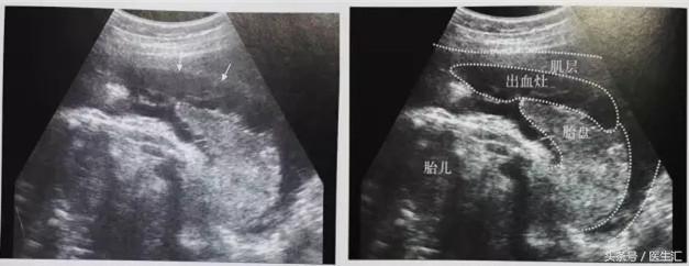 胎盘早剥是什么导致的,胎盘早剥是什么原因造成的胎儿肺炎
