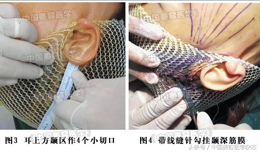 小切口线雕面部提升术视频,线雕面部提升术危害