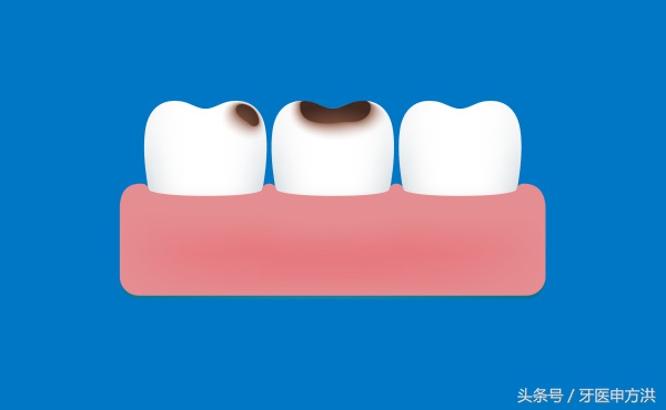 蛀牙一般从开始到牙神经需要多久,蛀牙从形成到黑洞需要多久