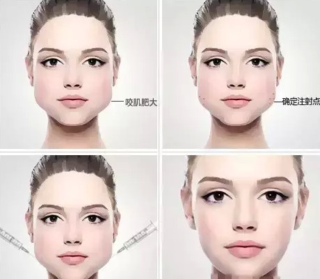 瘦脸针有基础版跟加强版吗,瘦脸针打一支有效果吗