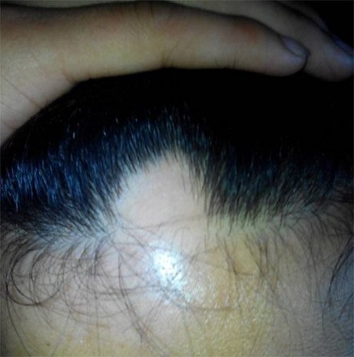 头发里的白色颗粒是脂溢性脱发吗,头痒抠出的黄泥是什么