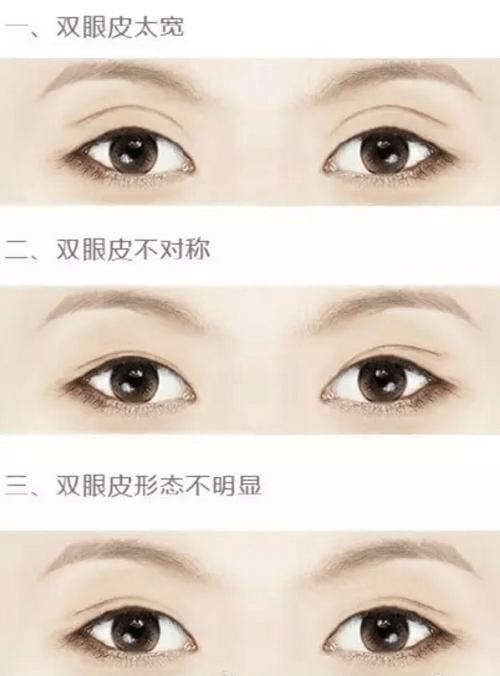 双眼皮原来这么简单自然无痕,做过的双眼皮如何看起来自然一些