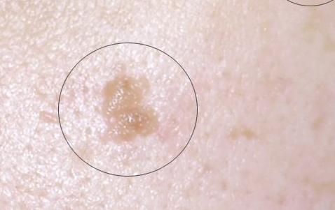 九价疫苗对扁平疣有预防作用吗,脸上长hpv扁平疣怎么预防