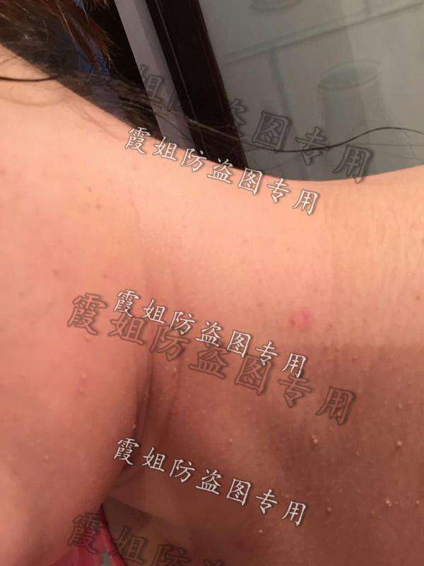 扁平疣｜快去点掉你的扁平疣，别传染给我