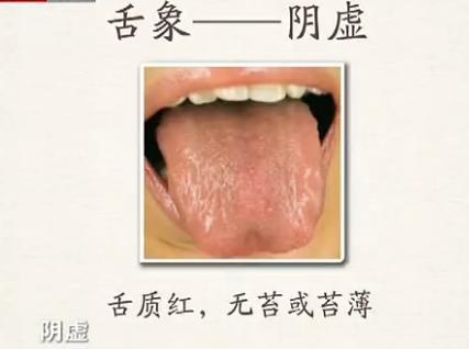 慢性咽炎喉咙痰多怎么治,慢性咽炎痰多异物感