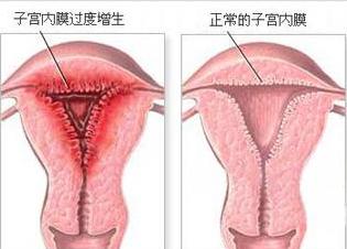 更年期子宫内膜增厚的症状和治疗,子宫内膜增厚怎么才能彻底治疗好
