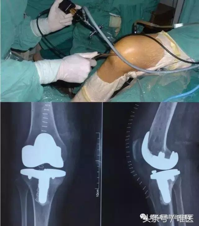 关节无名肿痛是什么原因引起的,关节肿痛无骨折