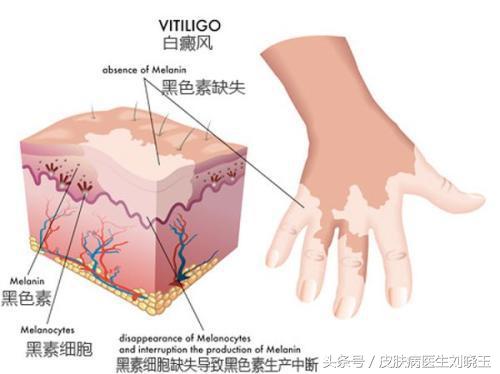 还在担心身上大面积的白癜风不可以治好吗,看完文章就知道了