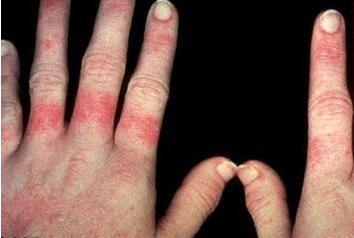 红斑狼疮这样记忆治疗，想不懂都难！