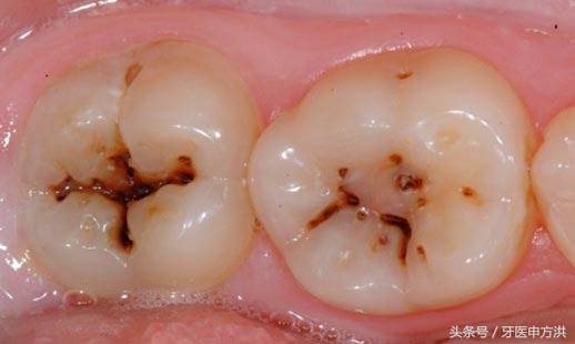 蛀牙一般从开始到牙神经需要多久,蛀牙从形成到黑洞需要多久