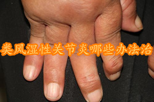 冷敷凝胶能治类风湿性关节炎吗,调整肠道菌群治类风湿性关节炎