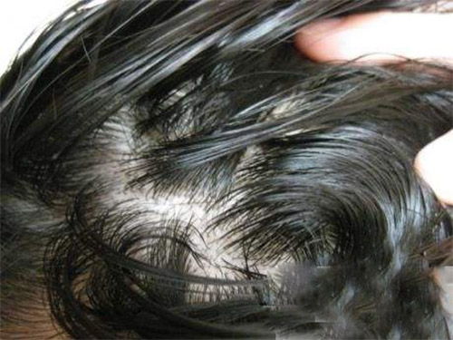 头发里的白色颗粒是脂溢性脱发吗,头痒抠出的黄泥是什么