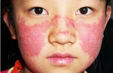 红斑狼疮这样记忆治疗，想不懂都难！