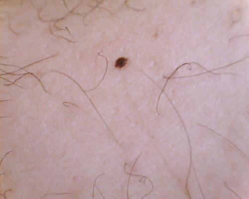 小孩身上长黑色痣越来越多,身上长黑色痣最近发痒怎么回事