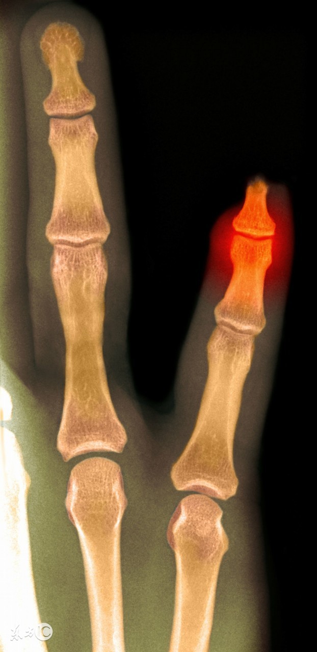 掌骨骨折手指变短,小拇指骨折后手指变形还能恢复吗