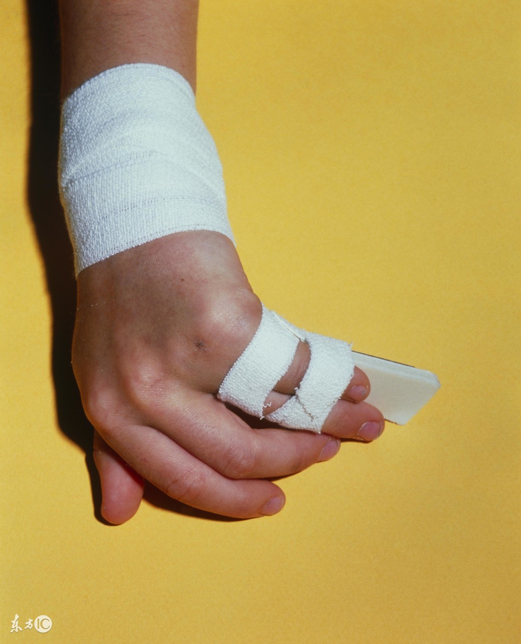 掌骨骨折手指变短,小拇指骨折后手指变形还能恢复吗