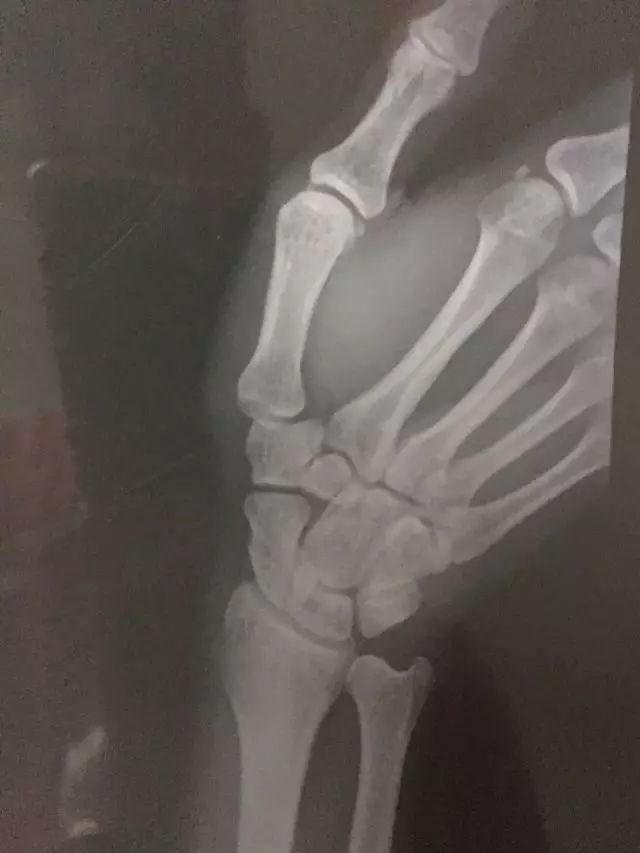 网球肘的最佳打法,如何发力避免网球肘