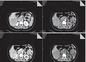 易恶变的良性瘤,阴超判断肿瘤良性恶性准确率