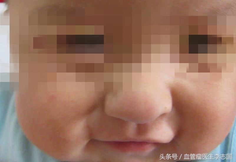 男童鼻子先天性堵塞,小孩鼻子恶性肿瘤