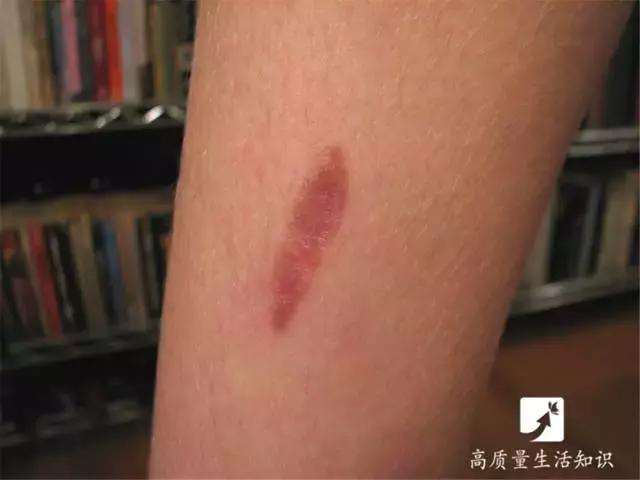 被开水烫伤紧急处理方法,不慎被开水烫伤急救方法