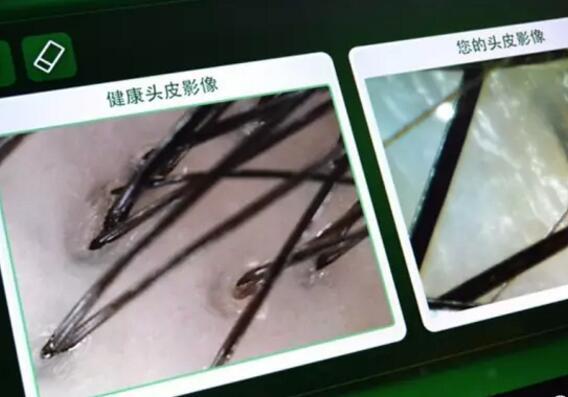 顽固头皮屑怎么根治,真正根治头皮屑的方法