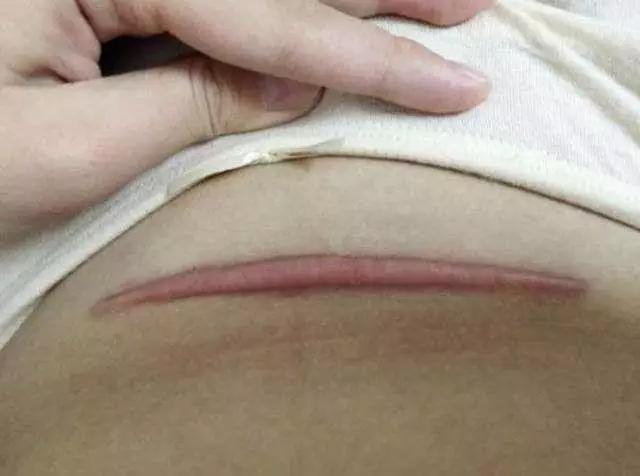 剖腹产几年了伤口流脓发臭,剖腹产后伤口为什么流脓