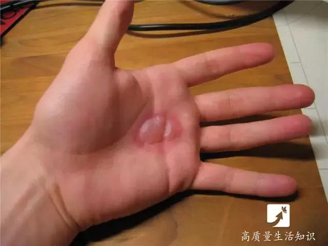 被开水烫伤紧急处理方法,不慎被开水烫伤急救方法