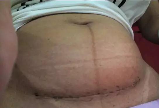 剖腹产几年了伤口流脓发臭,剖腹产后伤口为什么流脓