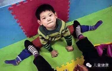 脑瘫和小儿脑瘫的区别,小儿脑瘫可以治疗好吗