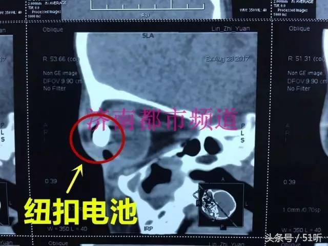 小孩误吞橡皮泥有伤害吗,一岁婴儿误食橡皮泥该如何处理