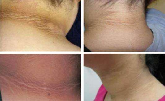 脖子上长疙瘩会是癌症吗,36岁男人脖子上长疙瘩图片大全