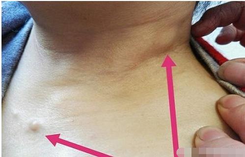 脖子上长疙瘩会是癌症吗,36岁男人脖子上长疙瘩图片大全