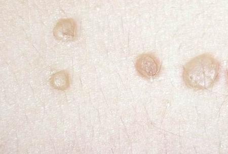 脸上的扁平疣是不是像青春痘,如何区分脸上的扁平疣和痘痘和斑