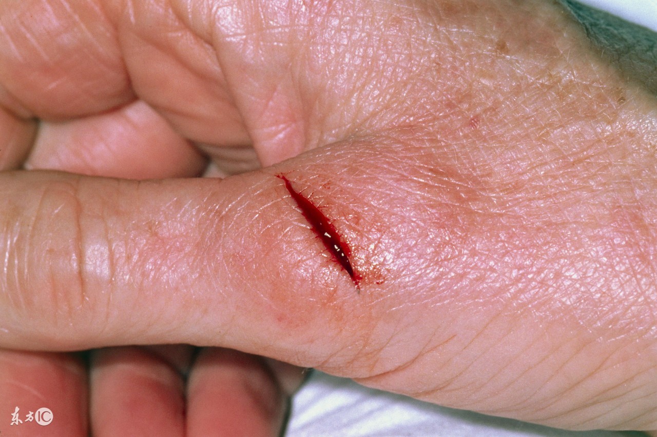 如果感染破伤风伤口会很快愈合吗,破伤风得扎多深才易得破伤风