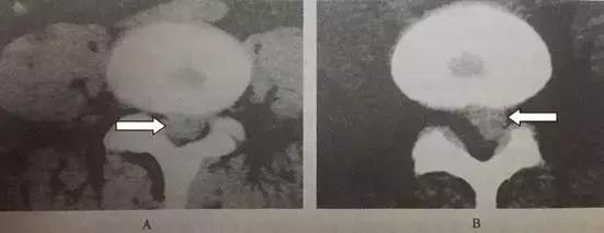 治疗腰椎间盘突出最佳最有效方法,腰椎间盘突出治疗视频大全