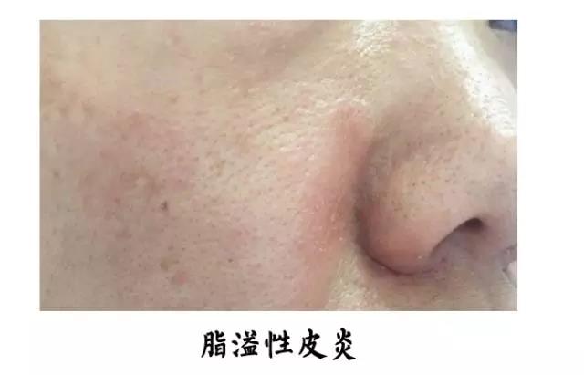 脂溢性皮炎和玫瑰痤疮会并发吗,脂溢性皮炎和玫瑰痤疮的区别