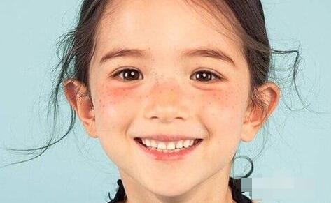 鼻梁黑色素沉积怎么办,鼻梁两侧黑色素沉积怎么遮