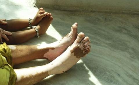 用了偏方白斑越治越严重?其实想要疾病痊愈,遵从四点就够了