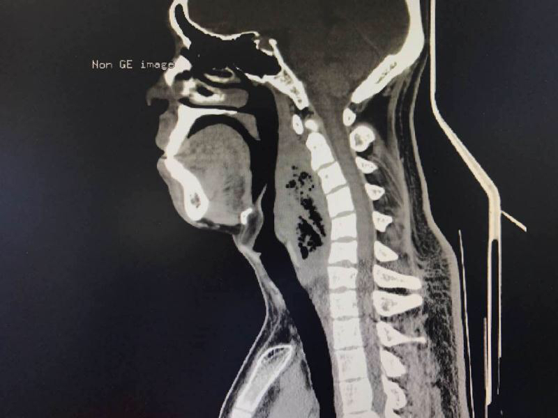 颈部脓肿的治疗方法,颈部脓肿洞比较深怎么治疗