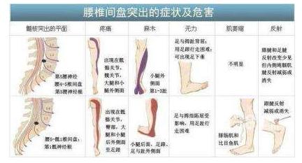 治疗腰椎间盘突出最佳最有效方法,腰椎间盘突出治疗视频大全