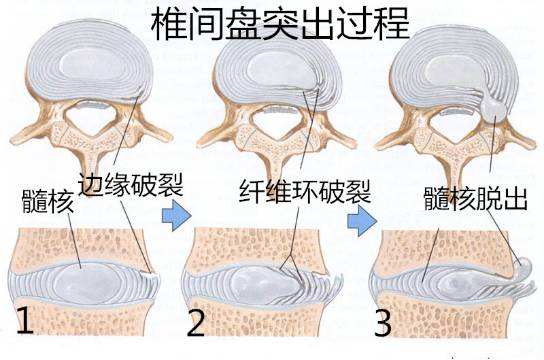治疗腰椎间盘突出最佳最有效方法,腰椎间盘突出治疗视频大全